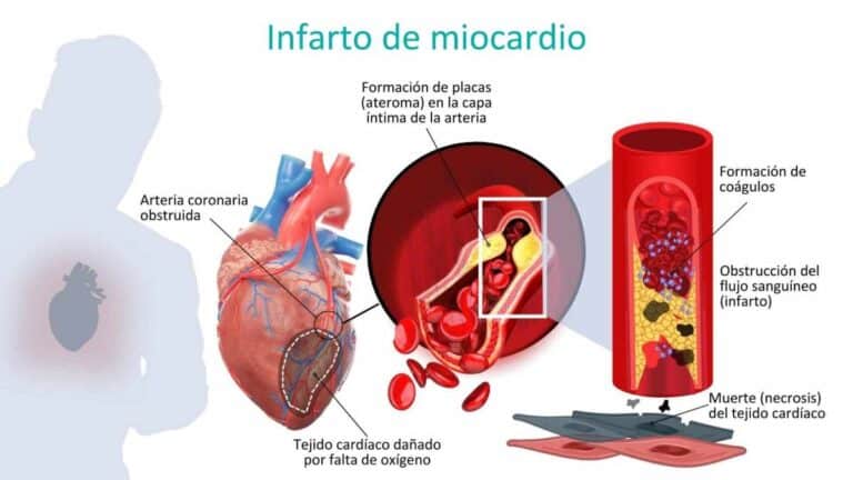 infarto-de-miocardio